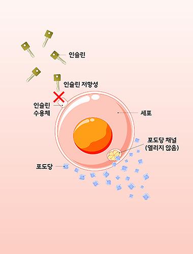 대사 이상과 인슐린 저항성